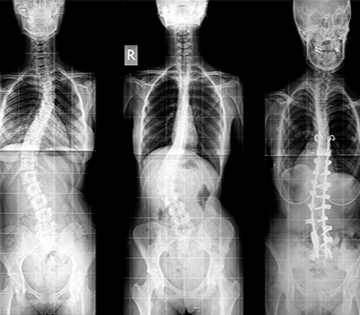 Scoliosis Cost In Bangkok Best Hospitals For Scoliosis In Bangkok