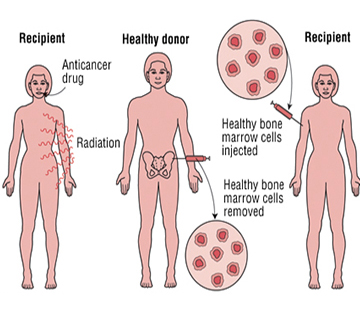 Bone Marrow Transplant Cost In Malaysia Bone Marrow Transplant In Malaysia