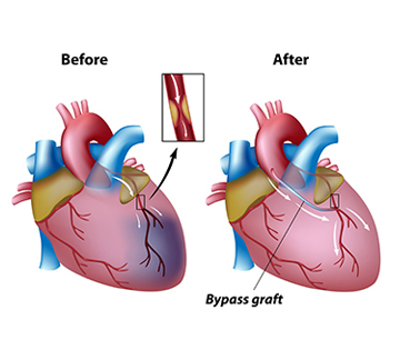 Coronary Artery Bypass Surgery Procedure, CABG Treatment