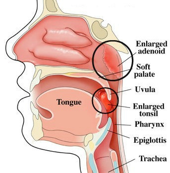 Adenoid Surgery Cost In India Adenoidectomy Cost In India